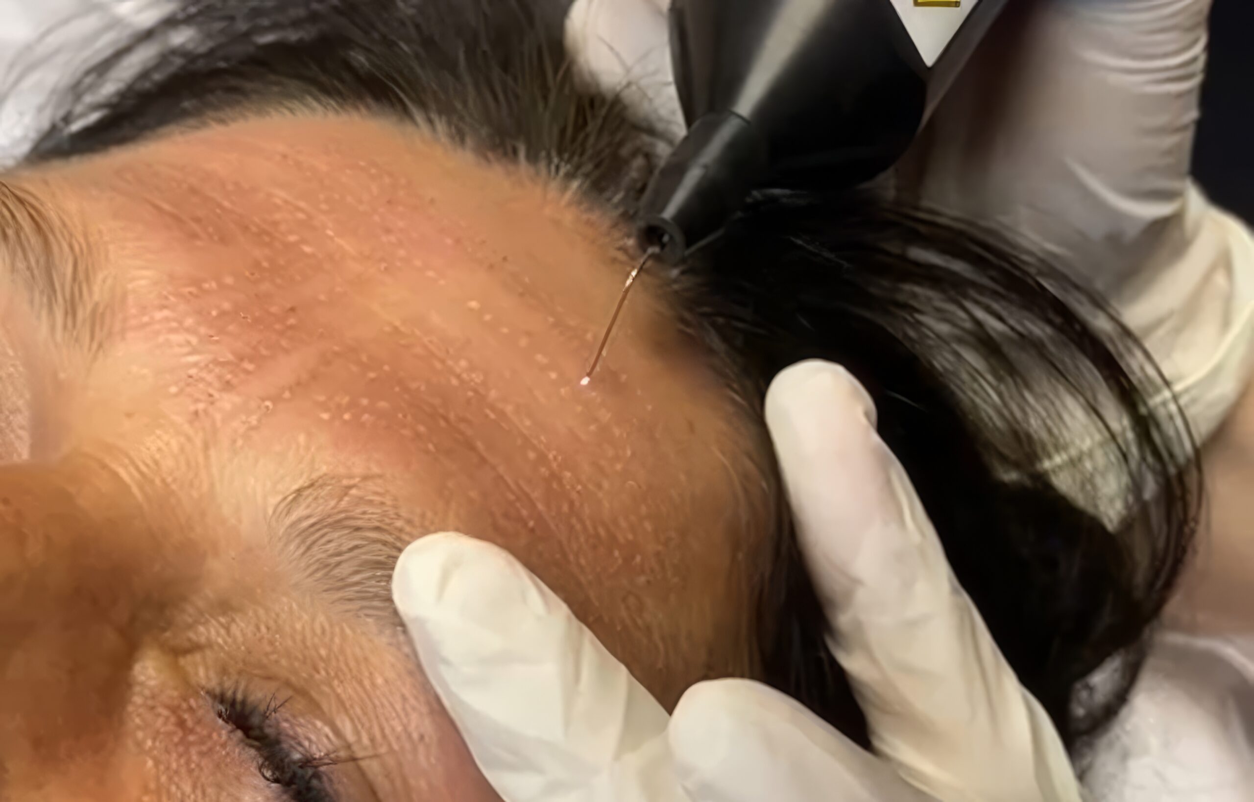 TopazPlasmatek-Plasma-Pen-enhance